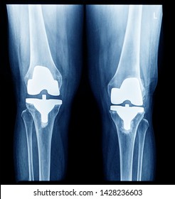 Film Xray Knee Joints Show Abnormal Stock Photo 1428236603 | Shutterstock