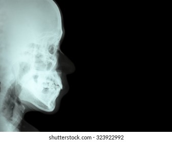 Nasal Bone X Ray Positioning