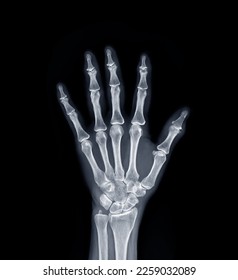 Film x-ray Left  Hand  AP view show  human's hands isolated  on black background . - Shutterstock ID 2259032089