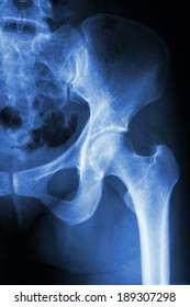 xray of normal and degenerative hip
