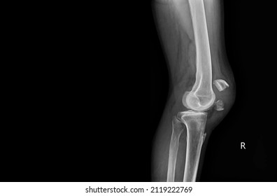 A film x-ray of left knee lateral view shown fracture of knee cap(patella) bone. The plain film on dark background with copy space.Medical concept.