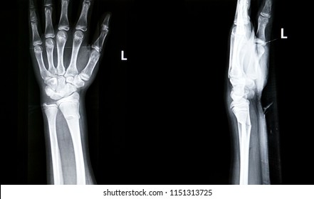 Film X-ray Left Wrist Join. Show Fracture Left Wrist