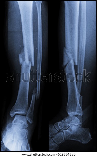 Film x-ray leg (AP ,\
Lateral view) : Comminuted fracture middle 1/3 of tibia and distal\
1/3 of fibula