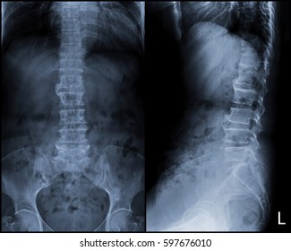 Film X-ray L-S Spine Or Lumbar Spine (AP,LAT View) : About 25% Anterior Compression Fracture Of T11 Vertebra, Causing Mild Kyphotic Angulation