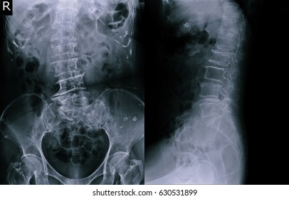 Film x-ray lumbar spine (AP,LAT view) : Dextroscoliosis with spondylosis of lumbar spine is noted.