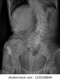 Film Xray Of Lumbar Spine Showing Bent Back Or Scoliosis With Chronic Back Pain, Kyphosis