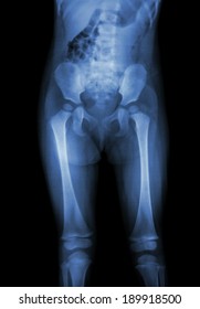 Film x-ray normal body of child (abdomen,buttock,thigh,knee)