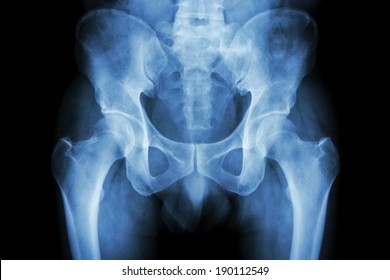 X Ray Pelvis Images Stock Photos Vectors Shutterstock