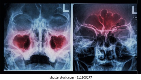 Film X-ray Paranasal Sinus : Show Sinusitis At Maxillary Sinus ( Left Image ) , Frontal Sinus ( Right Image )