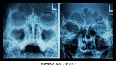 Film X-ray Paranasal Sinus Show Frontal Sinus , Maxillary Sinus , Ethmoid Sinus 