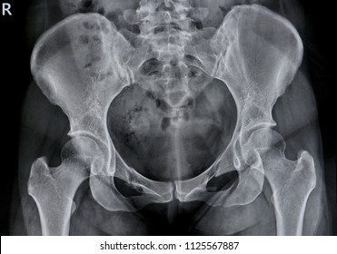 Film X-ray of Pelvis                               
