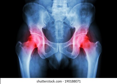 Film X-ray Pelvis And Arthritis Both Hip