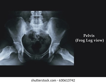 normal hip xray frog leg