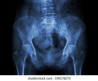 Film X-ray Pelvis Of Osteoporosis Patient