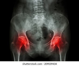 Film x-ray pelvis of osteoporosis patient and arthritis both hip