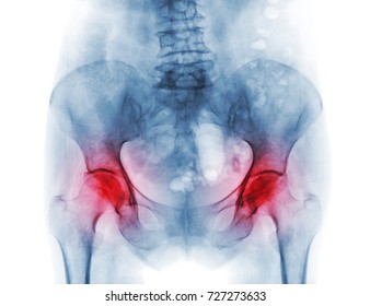 Film X-ray Pelvis Of Osteoporosis Patient And Arthritis Both Hip .