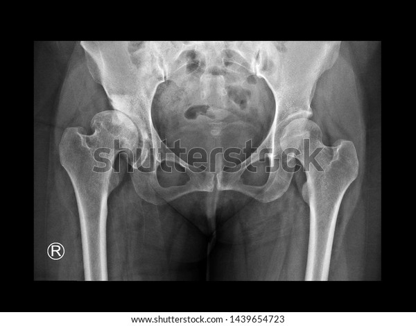 Film X-ray pelvis radiograph show developmental\
dysplasia of Right hip (DDH disease) with arthritis change. The\
patient has hip pain symptom. The Left hip show normal joint.\
Medical imaging concept