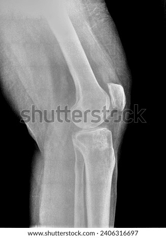 Film xray or radiograph of a normal knee. Lateral view show normal bone structure of patella femur tibia and fibula, joint space is normal with a fabella aka joint mice seen in the posterior