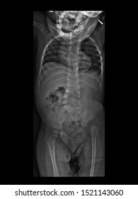 Film X-ray radiograph show congenital spine and hip abnormalities. The new born patient has unsegmented hemivertrebra spine and developmental dysplasia of hip(DDH) disease.  Congenital anomaly concept