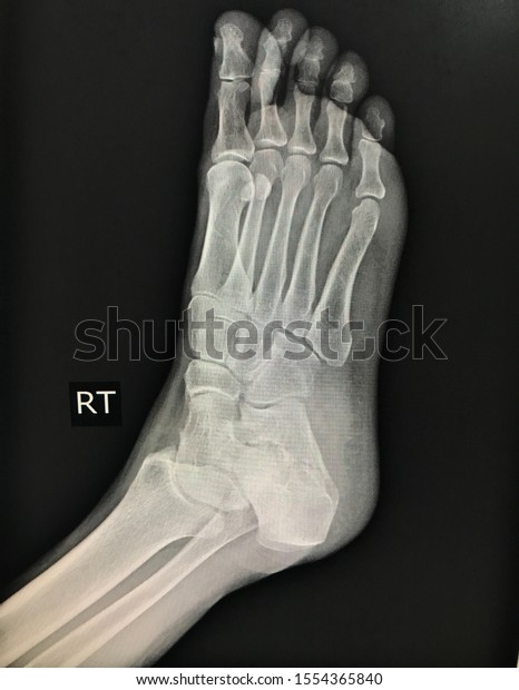 Film Xray Right Foot Oblique Position Stock Photo 1554365840 | Shutterstock
