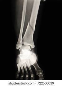 Film x-ray right leg show  tibia bone facture.
