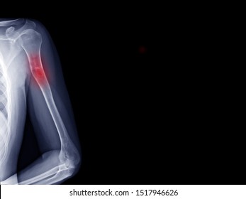 Film X-ray Shoulder Radiograph Show Aneurysmal Bone Cyst Disease (ABC) Which Benign Tumor Of Bone (osteolytic Bone Neoplasm). Highlight On Bone Lesion And Painful Area. Medical Oncology Concept