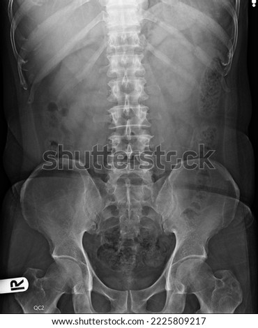 film  x-ray show abdomen and KUB