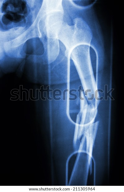 Film X-ray show comminute fracture shaft of femur\
(thigh bone). It was\
spliced