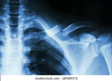 5 495 Broken Shoulder Royalty-Free Images, Stock Photos & Pictures ...