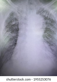 Film X-ray Show Diffuse Reticular Infiltration With Pulmonary Fibrosis With Widening Mediastinum Likely Enlarged Great Vessels