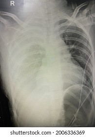 Film x-ray show hemothorax and bleeding from superior vena cava for medical and technology concept 