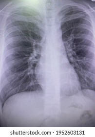 Film Xray Show Lung Tumors Right Stock Photo 1952603131 | Shutterstock