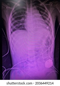 Film X-ray Show Patient Who Have Epicardium Permanent Pacemaker For  Who Have Completed Heart Block