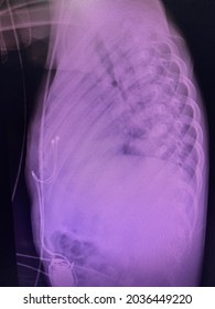 Film X-ray Show Patient Who Have Epicardium Permanent Pacemaker For  Who Have Completed Heart Block