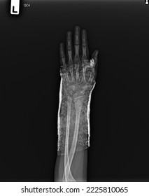 film  x-ray show short arm cast - Shutterstock ID 2225810065
