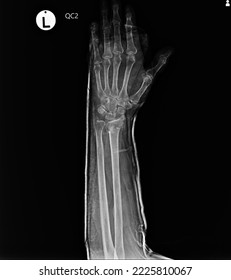 film  x-ray show short arm cast - Shutterstock ID 2225810067