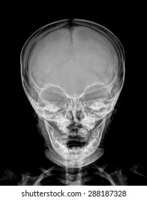 child skull xray