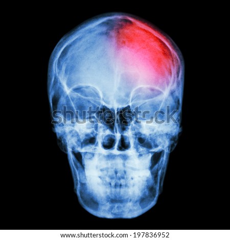 Film X-ray skull and headache. (Stroke,Cerebrovascular accident)