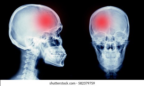 Film X-ray Skull Of Human With Cerebrovascular Accident Area Or Hemorrhage Stroke.