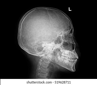 Film x-ray Skull lateral : show normal human's skull and cervical spine and blank area at right side