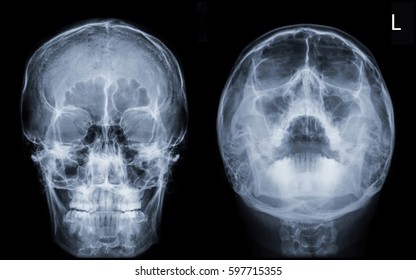 Film x-ray Skull / PNS (Caldwell , Water's view) : show normal human's skull / PNS