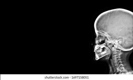 Film X-ray Skull Radiograph Show Adenoid Hypertrophy. Enlarged Adenoid Is Abnormal Growth(hypertrophy) Of Adenoid(pharyngeal Tonsil) That Cause Airway Obstruction In Children. Medical Imaging Concept