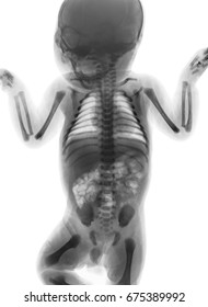 Film x-ray whole body of normal infant . front view .