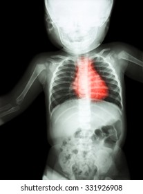 Film X-ray Whole Child 's Body With Heart Disease ( Rheumatic Heart Disease , Valvular Heart Disease ) ( Cardiovascular System )