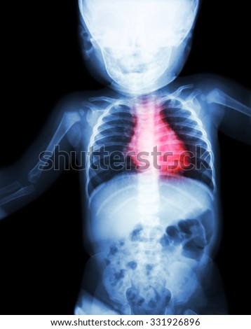 Film x-ray whole child 's body with heart disease ( Rheumatic heart disease , Valvular heart disease ) ( Cardiovascular system )