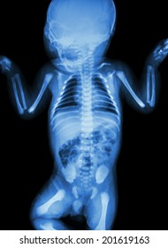 film x-ray whole infant's body