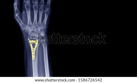 Film X-ray wrist radiograph show lower end of forearm bone broken (distal end radius fracture) treatment by plate fixation surgery (ORIF operation). Orthopedic implant and medical technology concept.