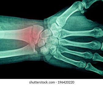 Film X-ray Wrist Show Fracture Distal Radius