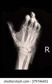 Film X-ray Wrist Show Fracture Distal Radius
