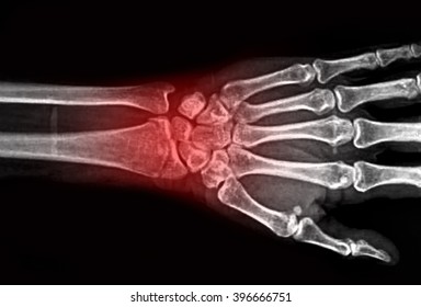 Film X-ray Wrist Show Fracture Distal Radius